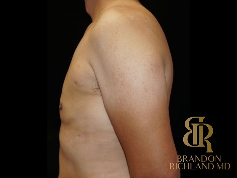Gynecomastia Surgery After photo, Patient 02