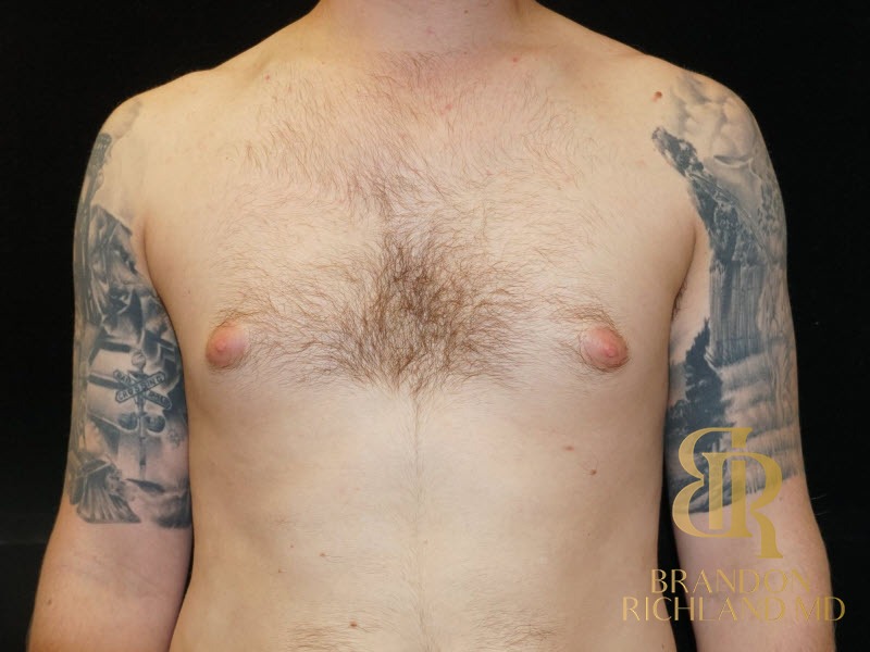 Gynecomastia Surgery Before photo, Patient 03