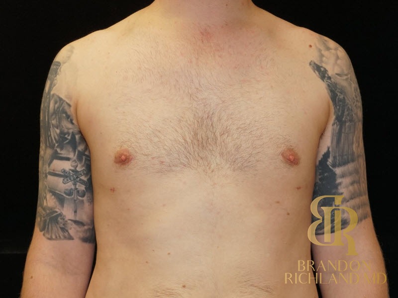 Gynecomastia Surgery After photo, Patient 03