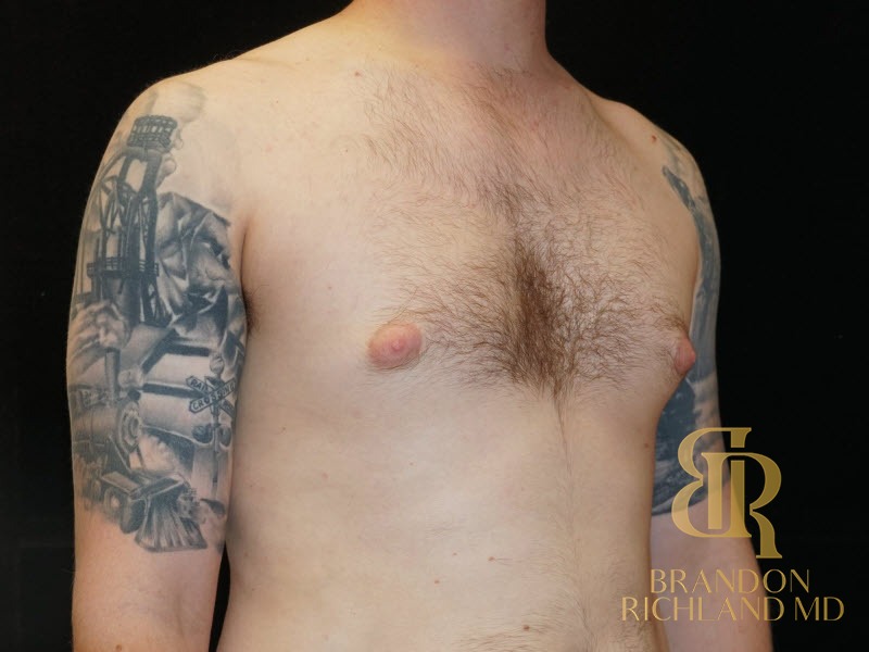 Gynecomastia Surgery Before photo, Patient 03