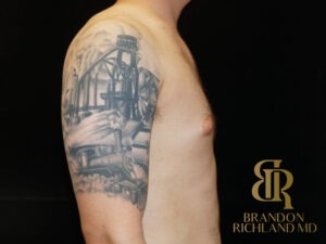 Gynecomastia Surgery before and after, Patient 03 — Dr. Brandon Richland, Newport Beach