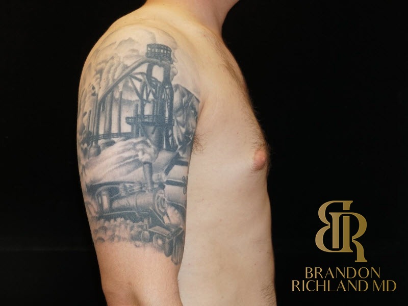 Gynecomastia Surgery Before photo, Patient 03