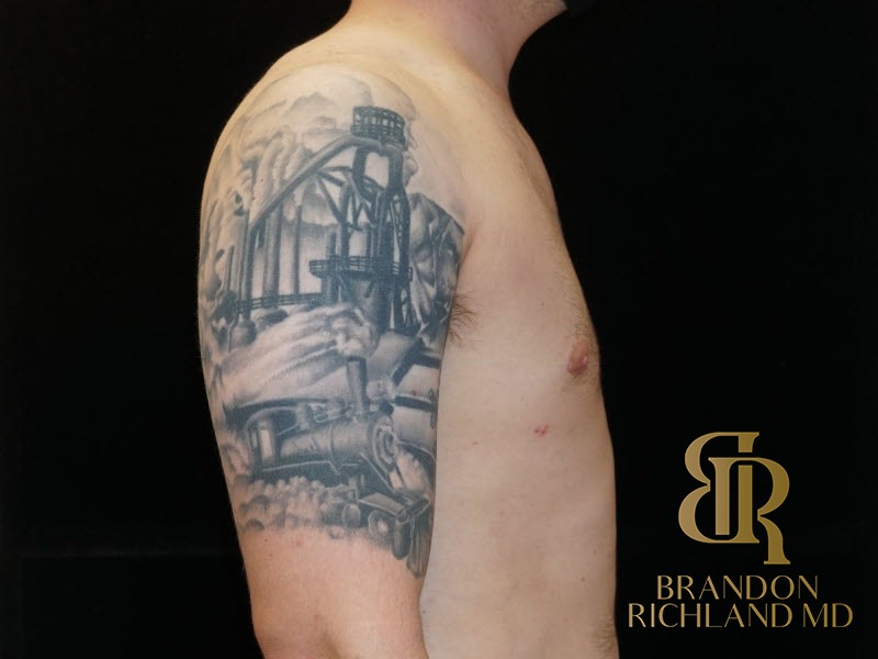 Gynecomastia Surgery After photo, Patient 03