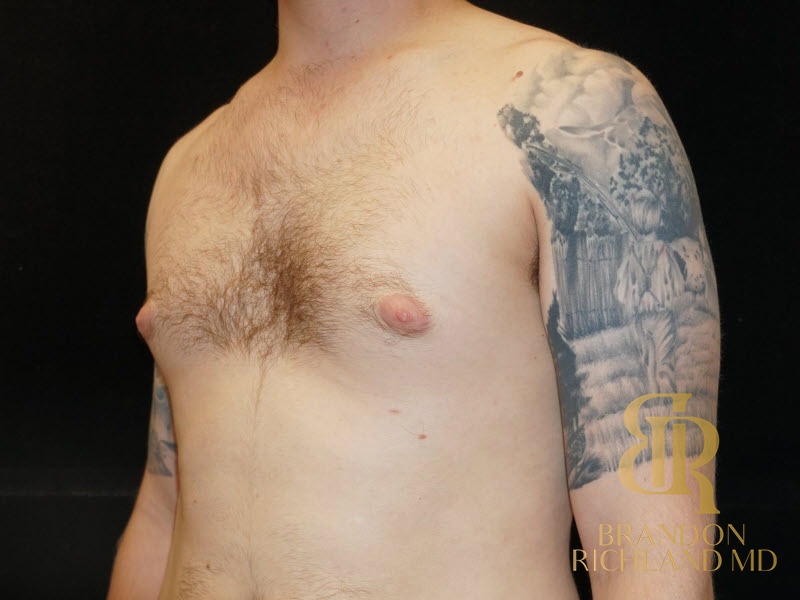 Gynecomastia Surgery Before photo, Patient 03