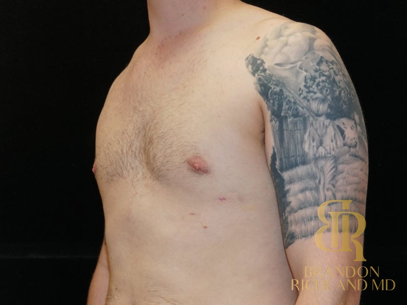 Gynecomastia Surgery After photo, Patient 03