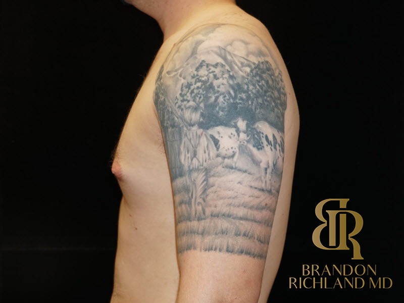 Gynecomastia Surgery Before photo, Patient 03