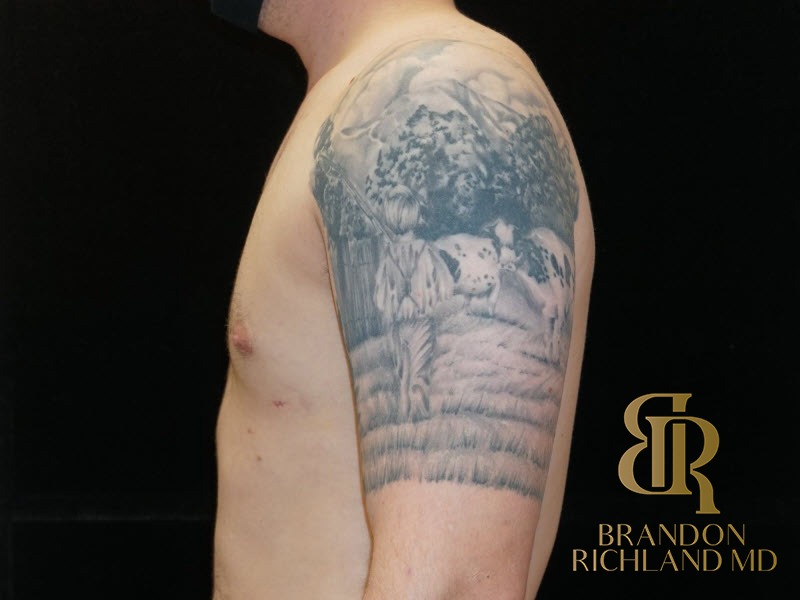 Gynecomastia Surgery After photo, Patient 03