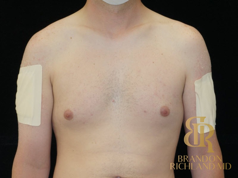 Gynecomastia Surgery Before photo, Patient 04