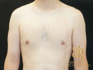 Gynecomastia Surgery before and after, Patient 04 — Dr. Brandon Richland, Newport Beach