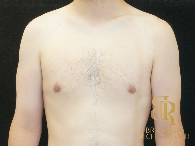 Gynecomastia Surgery After photo, Patient 04