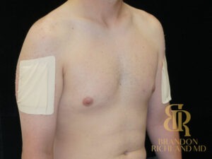 Gynecomastia Surgery before and after, Patient 04 — Dr. Brandon Richland, Newport Beach