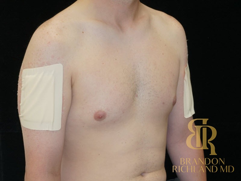 Gynecomastia Surgery Before photo, Patient 04