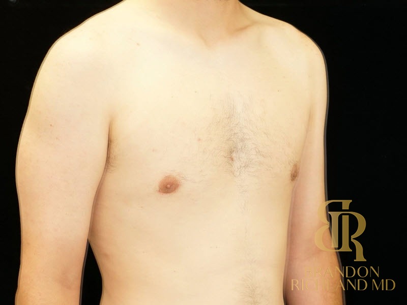 Gynecomastia Surgery After photo, Patient 04