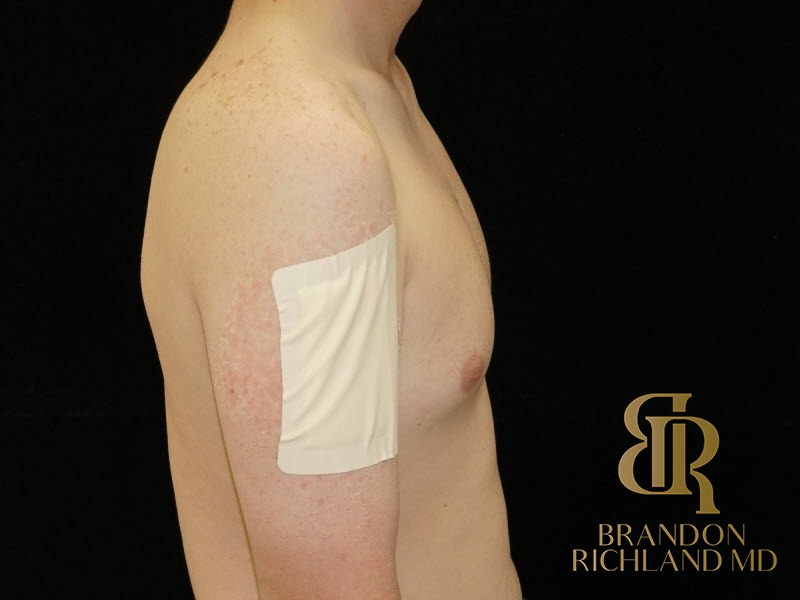 Gynecomastia Surgery Before photo, Patient 04