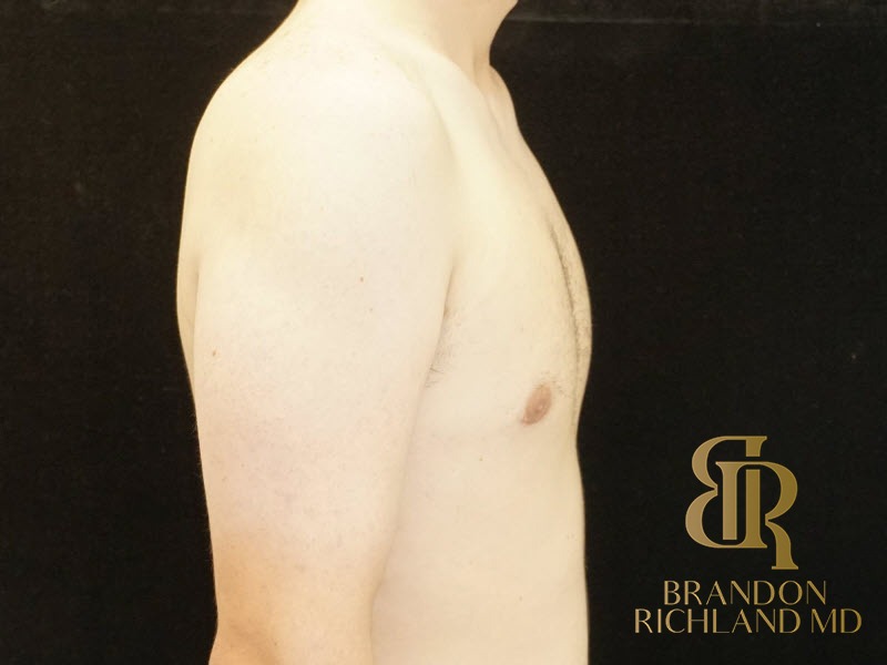 Gynecomastia Surgery After photo, Patient 04