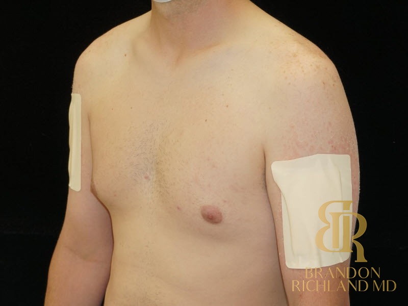 Gynecomastia Surgery Before photo, Patient 04
