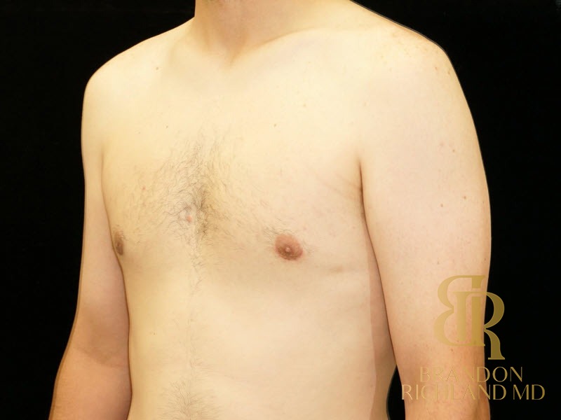 Gynecomastia Surgery After photo, Patient 04