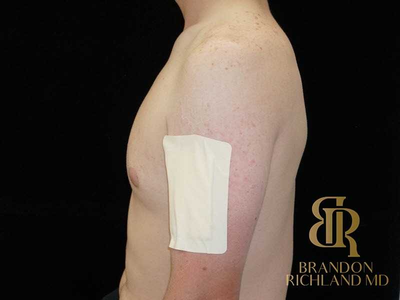 Gynecomastia Surgery Before photo, Patient 04