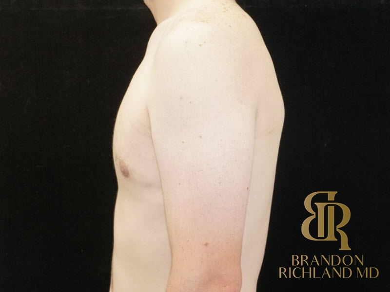 Gynecomastia Surgery After photo, Patient 04