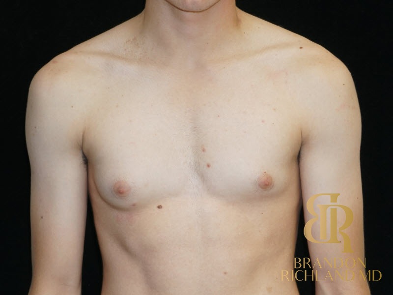 Gynecomastia Surgery Before photo, Patient 05