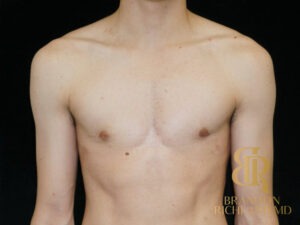 Gynecomastia Surgery before and after, Patient 05 — Dr. Brandon Richland, Newport Beach