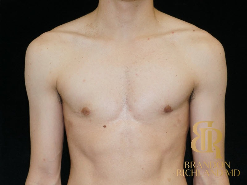 Gynecomastia Surgery After photo, Patient 05