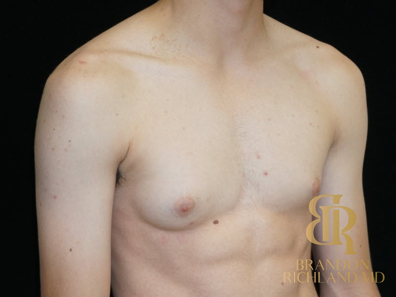 Gynecomastia Surgery Before photo, Patient 05