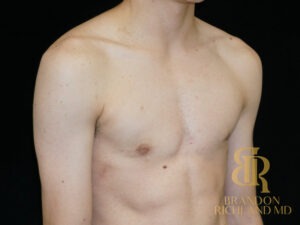 Gynecomastia Surgery before and after, Patient 05 — Dr. Brandon Richland, Newport Beach