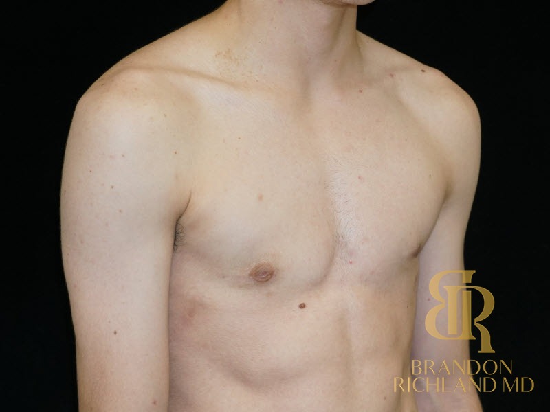 Gynecomastia Surgery After photo, Patient 05