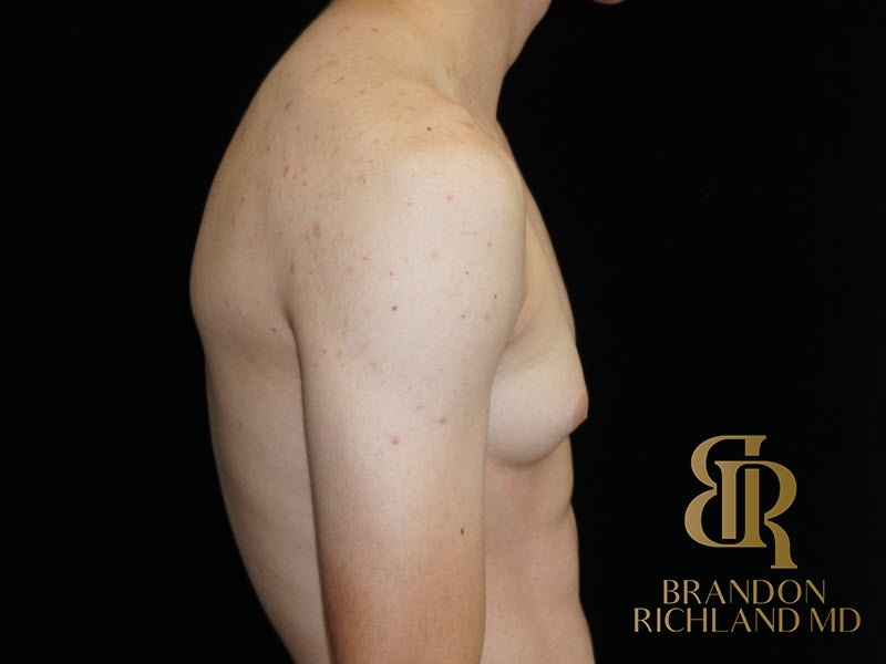 Gynecomastia Surgery Before photo, Patient 05