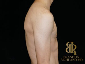 Gynecomastia Surgery before and after, Patient 05 — Dr. Brandon Richland, Newport Beach