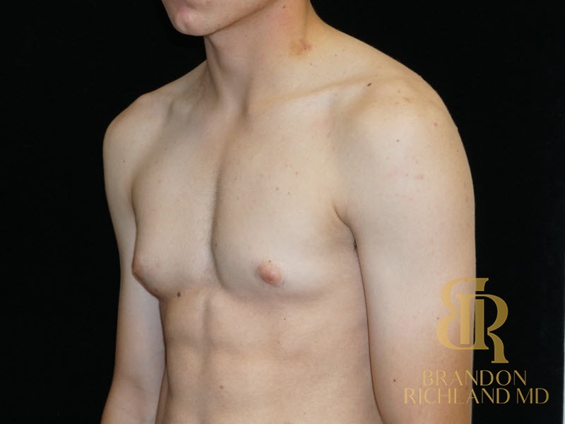 Gynecomastia Surgery Before photo, Patient 05