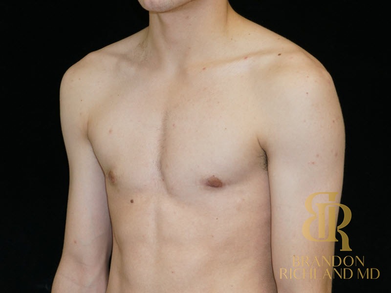 Gynecomastia Surgery After photo, Patient 05