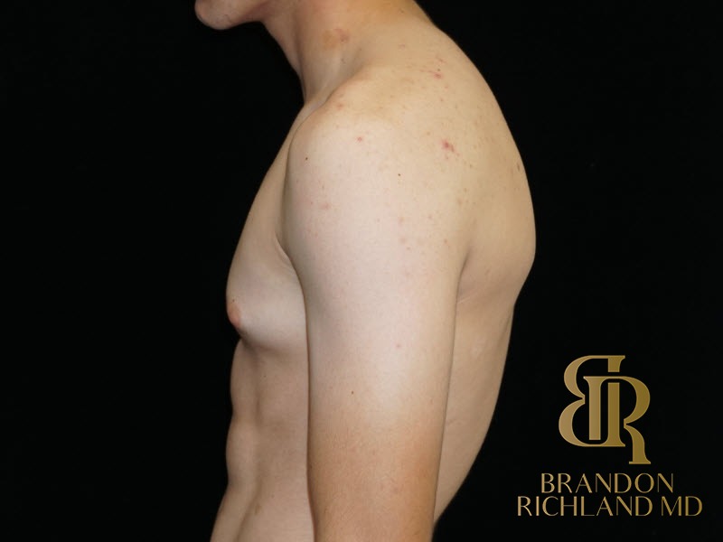Gynecomastia Surgery Before photo, Patient 05