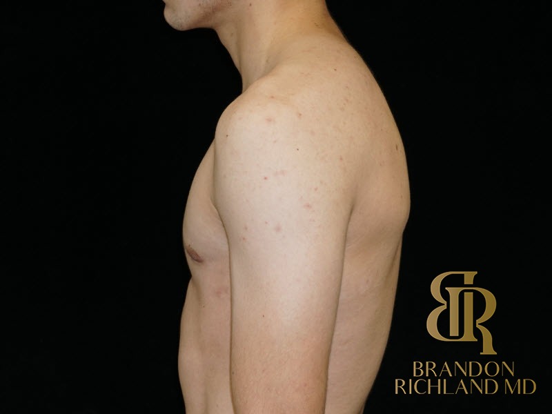 Gynecomastia Surgery After photo, Patient 05