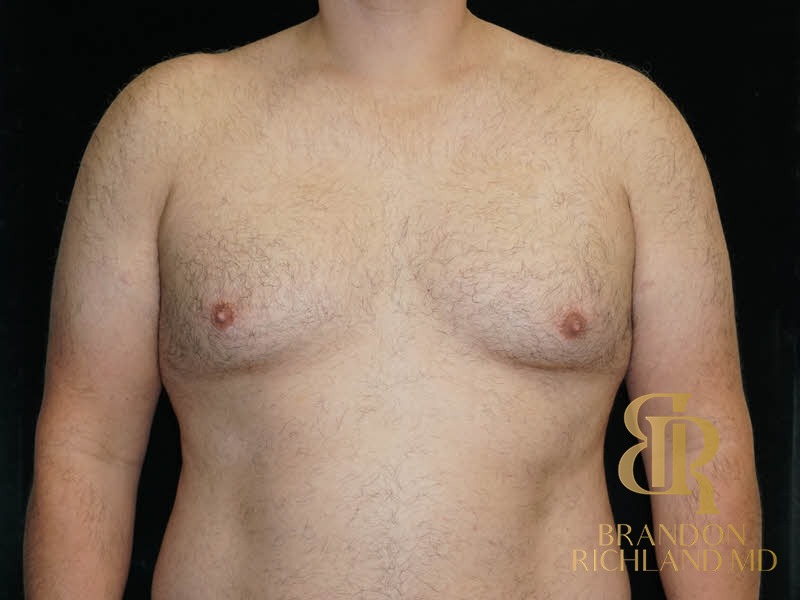 Gynecomastia Surgery Before photo, Patient 06