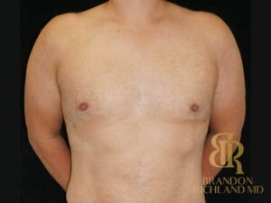 Gynecomastia Surgery before and after, Patient 06 — Dr. Brandon Richland, Newport Beach