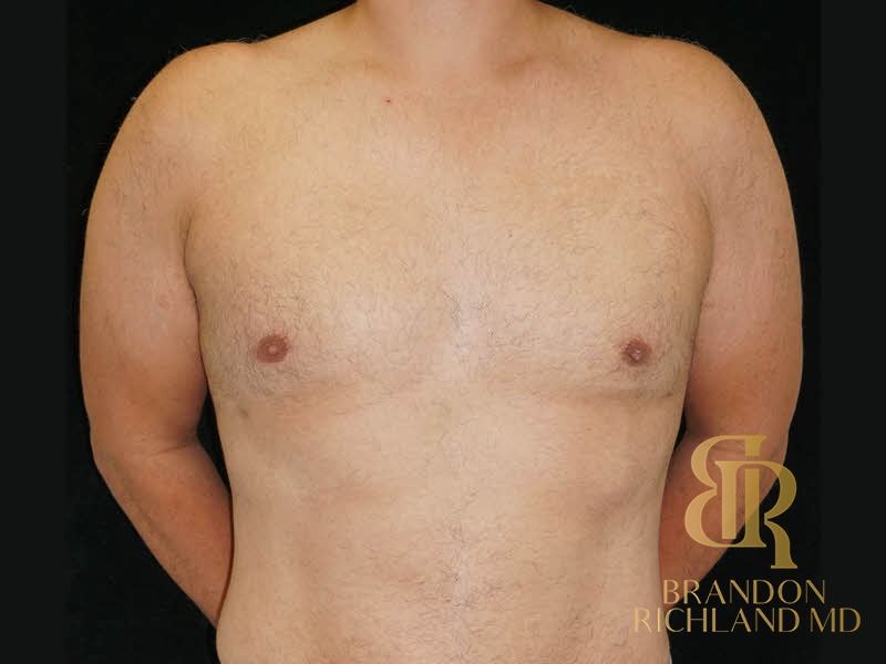 Gynecomastia Surgery After photo, Patient 06