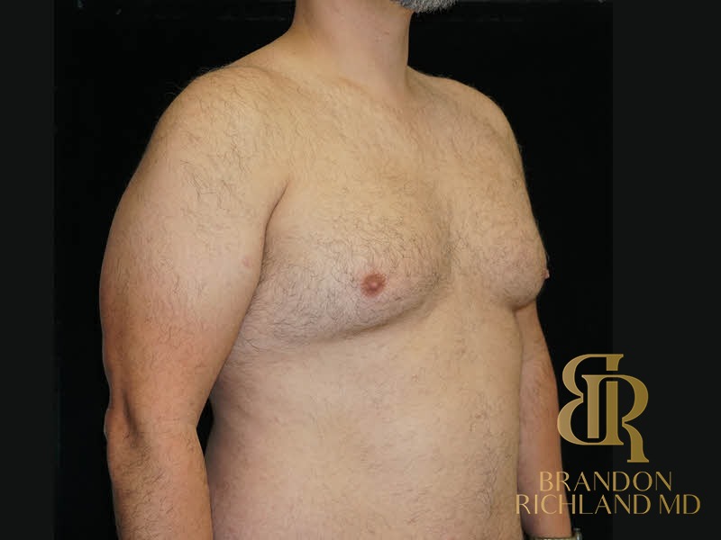 Gynecomastia Surgery Before photo, Patient 06