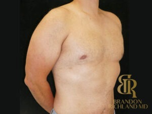 Gynecomastia Surgery before and after, Patient 06 — Dr. Brandon Richland, Newport Beach