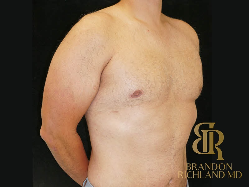 Gynecomastia Surgery After photo, Patient 06