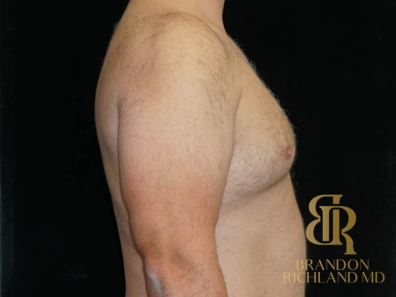 Gynecomastia Surgery Before photo, Patient 06