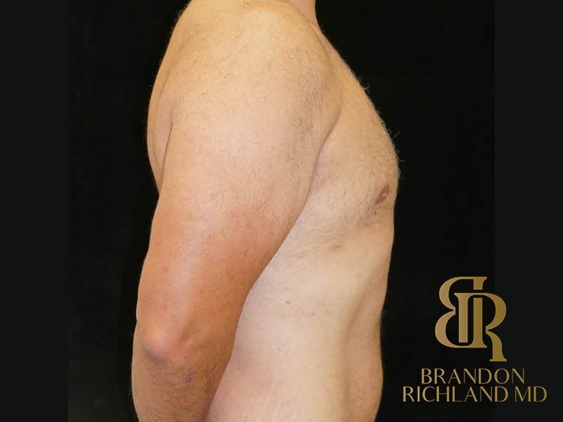 Gynecomastia Surgery After photo, Patient 06