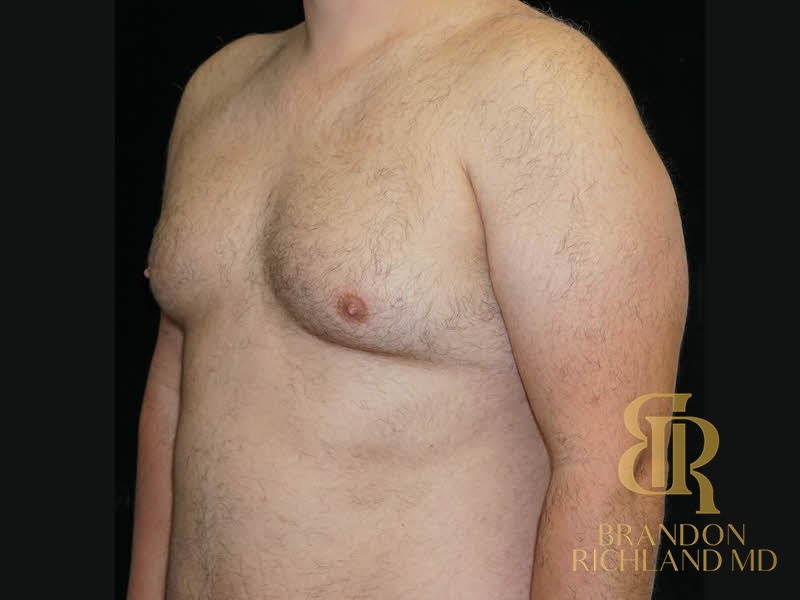 Gynecomastia Surgery Before photo, Patient 06