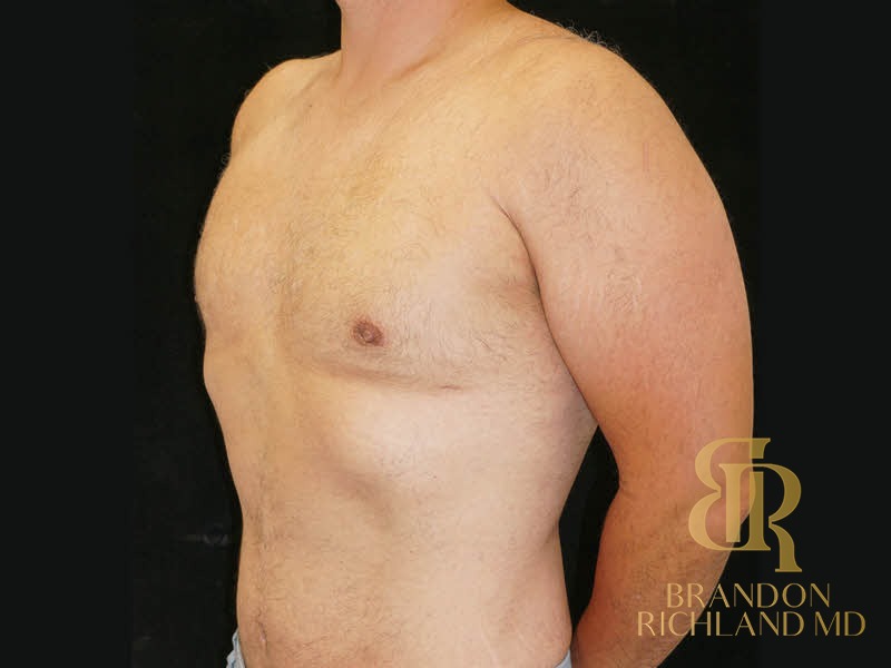 Gynecomastia Surgery After photo, Patient 06