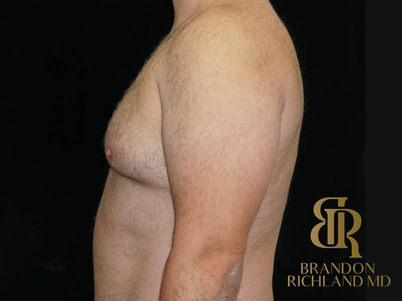 Gynecomastia Surgery Before photo, Patient 06