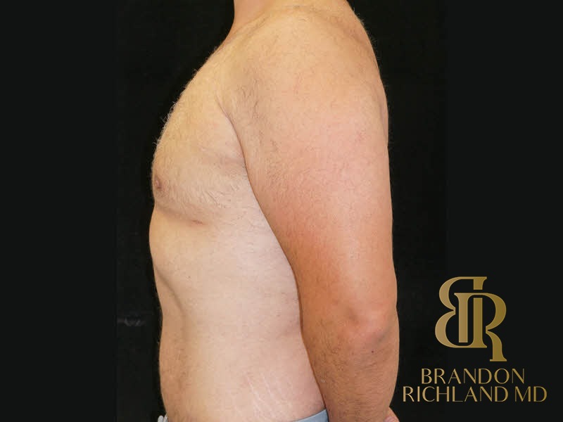 Gynecomastia Surgery After photo, Patient 06