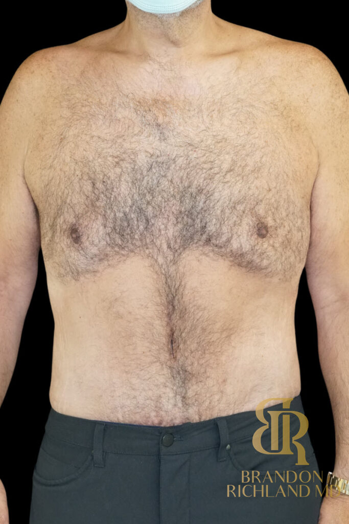 Gynecomastia Surgery After photo, Patient 07