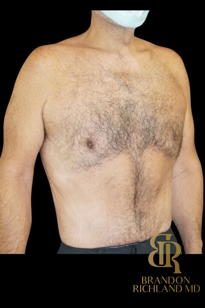 Gynecomastia Surgery After photo, Patient 07
