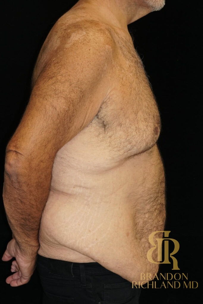 Gynecomastia Surgery Before photo, Patient 07